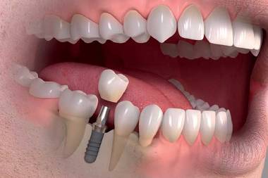 Best dental implant services in Mahalunge