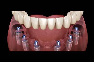 Dental Implant Services in Mahalunge