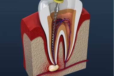 Best dental implant services in Mahalunge
