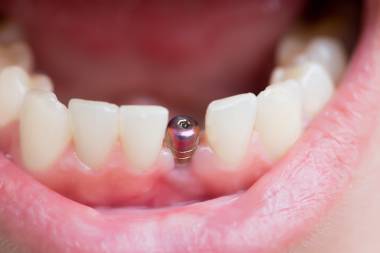 Dental Implant Services in Mahalunge
