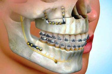 Surgical Orthodontics