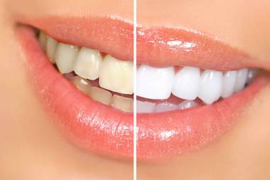 Best dental implant services in Mahalunge