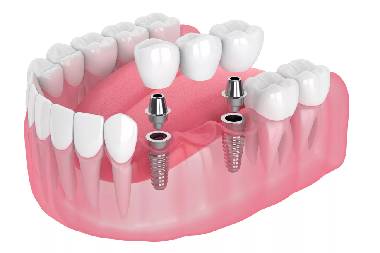 Best dental implant services in Mahalunge