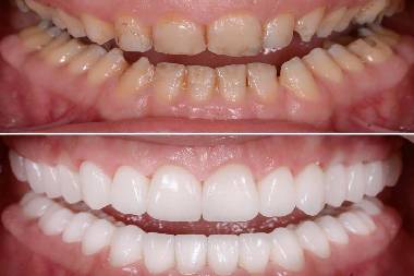 Best dental implant services in Mahalunge