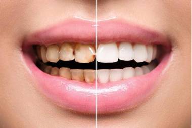 Best dental implant services in Mahalunge