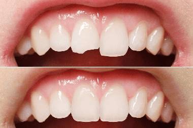 Best dental implant services in Mahalunge